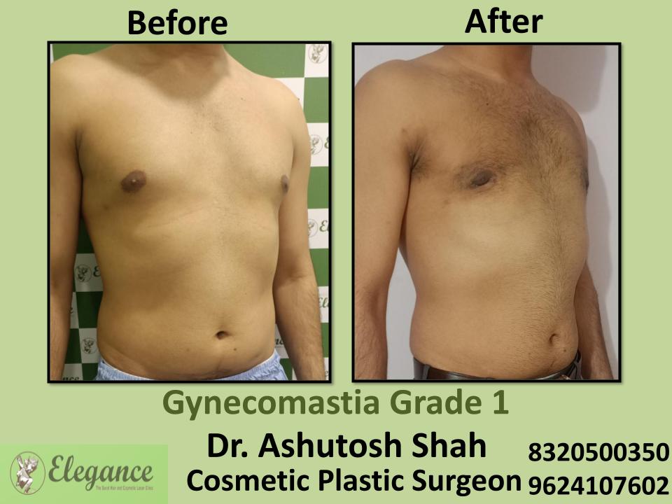 Gyencomastia Grade 1, Man Boobs, Treatment By Best Surgeons, Laldarwaja, Katargam, Umra, Surat, Gujarat.