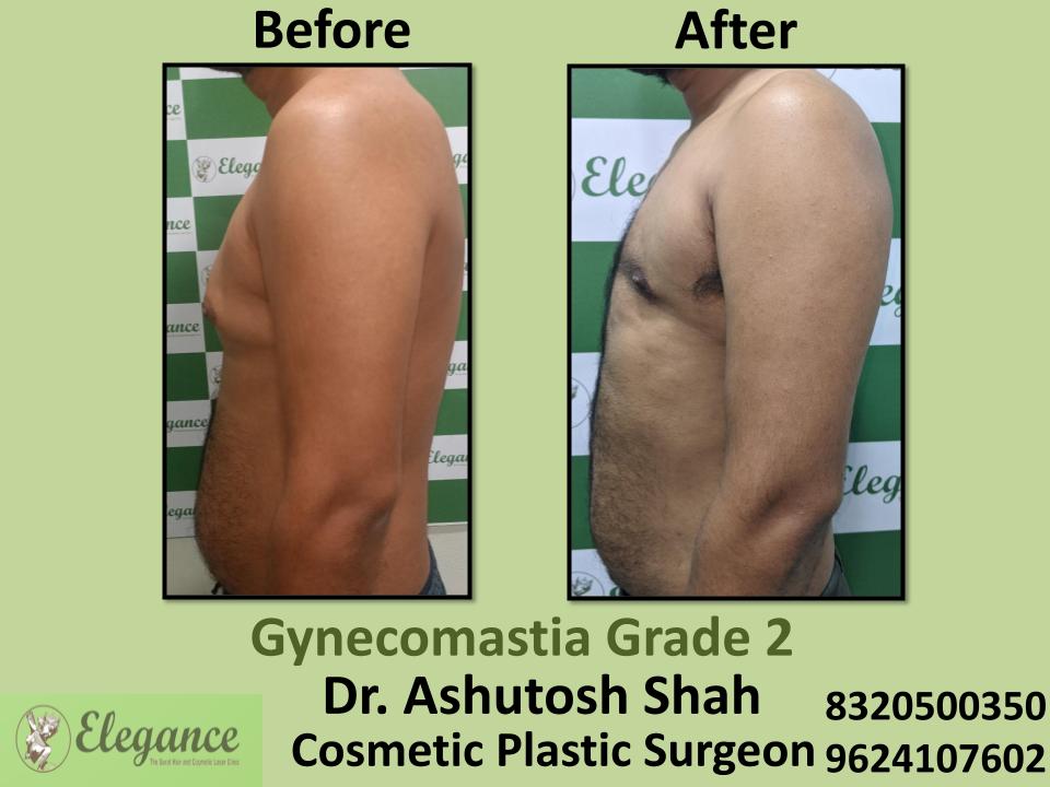 Gyencomastia Grade 2, Surgical Pocedure, Male Breast Enlargement, Pal, Adajan, Umra, Vesu, Surat, Gujarat.