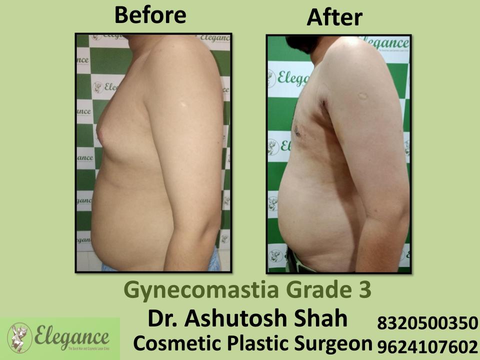 Gyencomastia Grade 3, Best Surgeons, Removing Fat Of Chest, Jhangirpura, Pal, Palanpor, Surat, Gujarat.