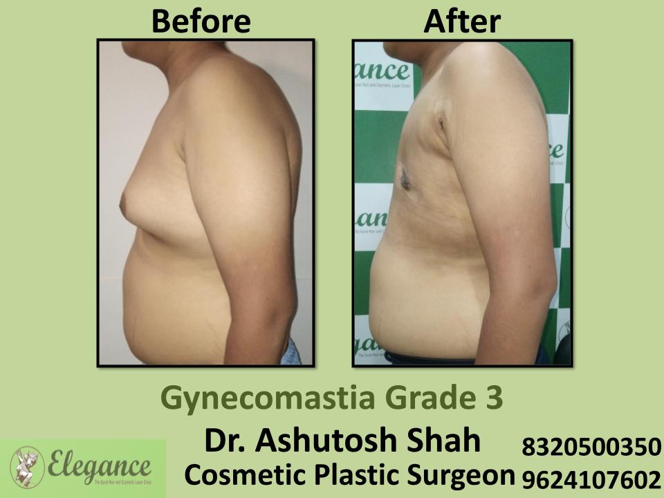 Gyencomastia Grade 3, Enlarged Male Breast, Nanpura, Pandesara, Navsari, Surat, Gujarat.