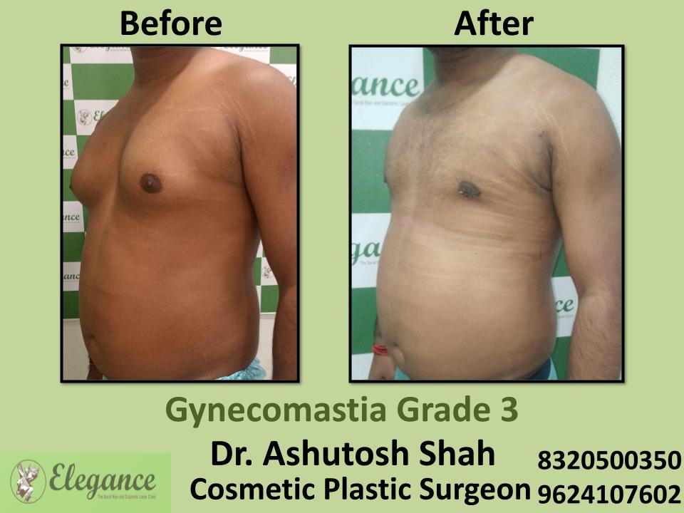 Gyencomastia Grade 3, Gyencomastia Suregery Recovery, Jahangirpura, Bhatar, Udhna, Surat, Gujarat.