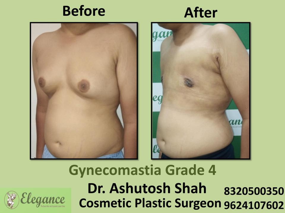 Gyencomastia Grade 3, Hormonal Imbalance And Gynecomastia, Tapi, Narmada, Bharuch, Surat, Gujarat.