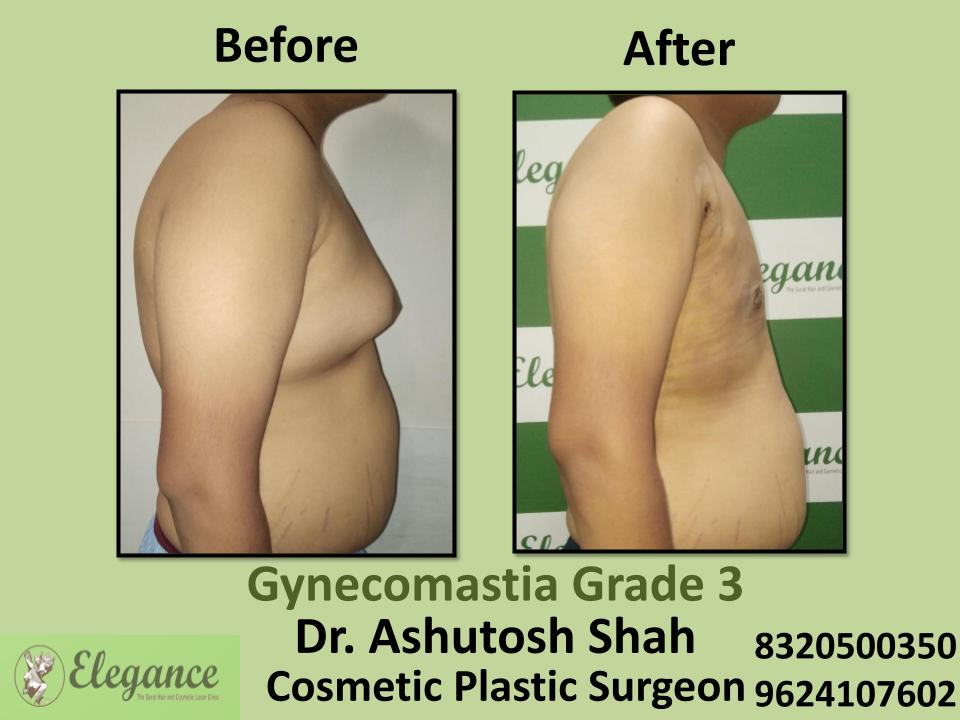 Gyencomastia Grade 3, Male Breast Reduction, Dindoli, Pandesara, Udhna, Surat, Gujarat.