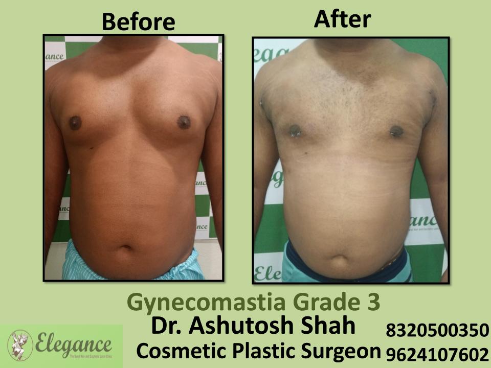 Gyencomastia Grade 3, Male Breast Reduction, Surgical Procedure, Rander, Olpad, Kim, Surat, Gujarat.