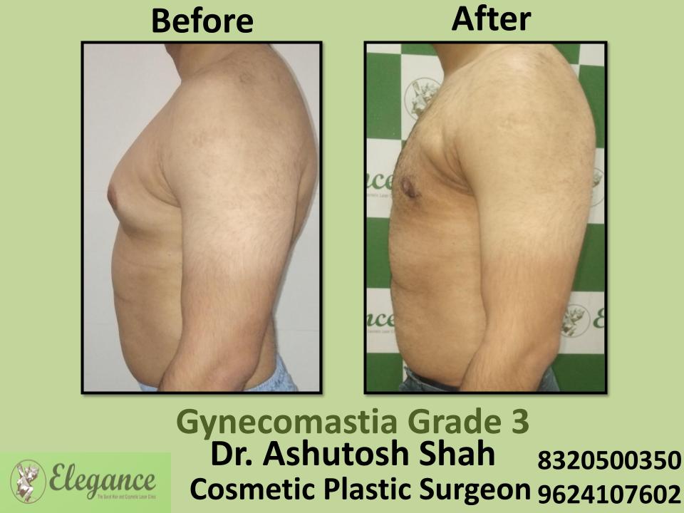 Gyencomastia Grade 3, Male Chest Fat Accumilation, Suregery Is Solution, Gopipura, Majura, Rander, Surat, Gujarat.