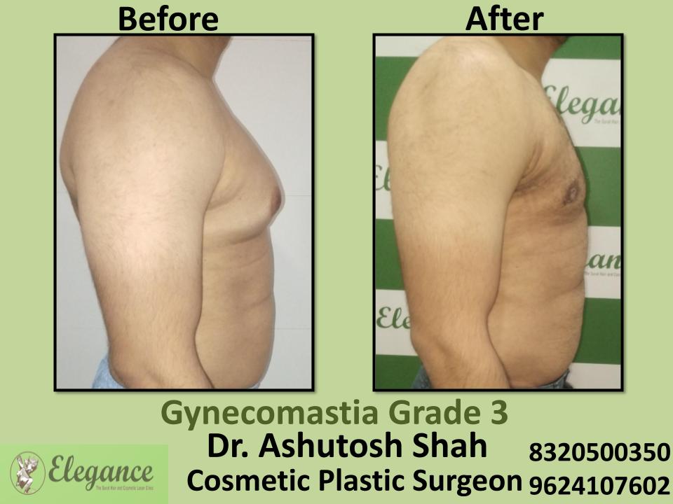 Gyencomastia Grade 3, Puffy Nipples In Males, Surgery Is The Treatment, Kim, Kosamaba, Bardoli, Surat, Gujarat.