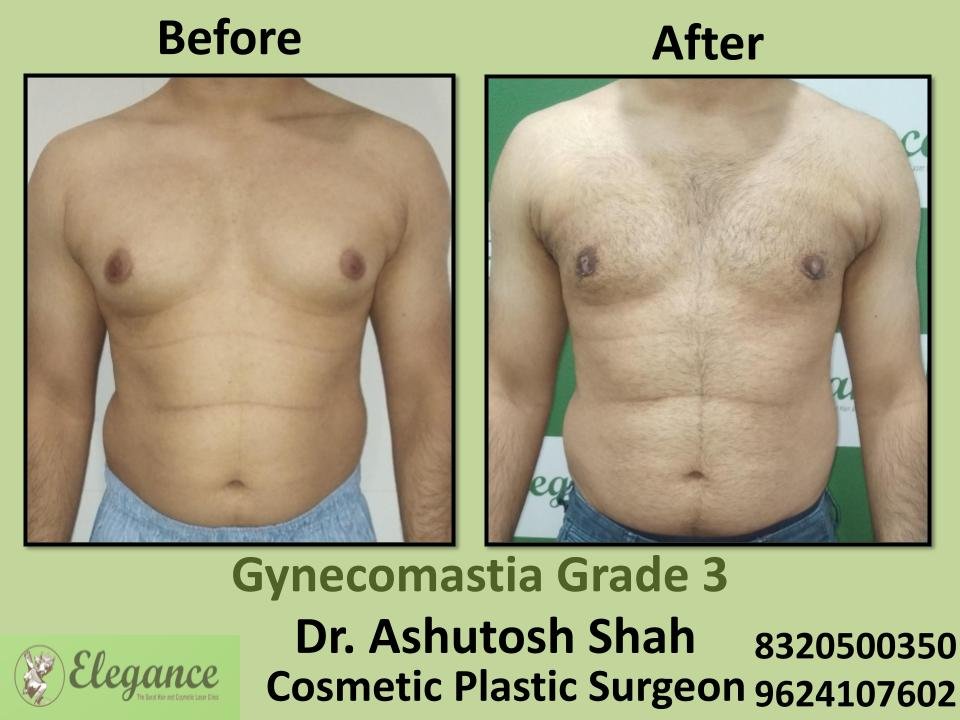 Gyencomastia Grade 3, Surgical Correction For Gynecomastia, Best Surgeons, Rander, Olpad, Kim, Surat, Gujarat.