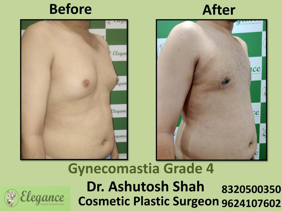 Gyencomastia Grade 4, Large And Sagging Male Breasts, Majura, Nanavaraccha, Dindoli, Surat, Gujarat.