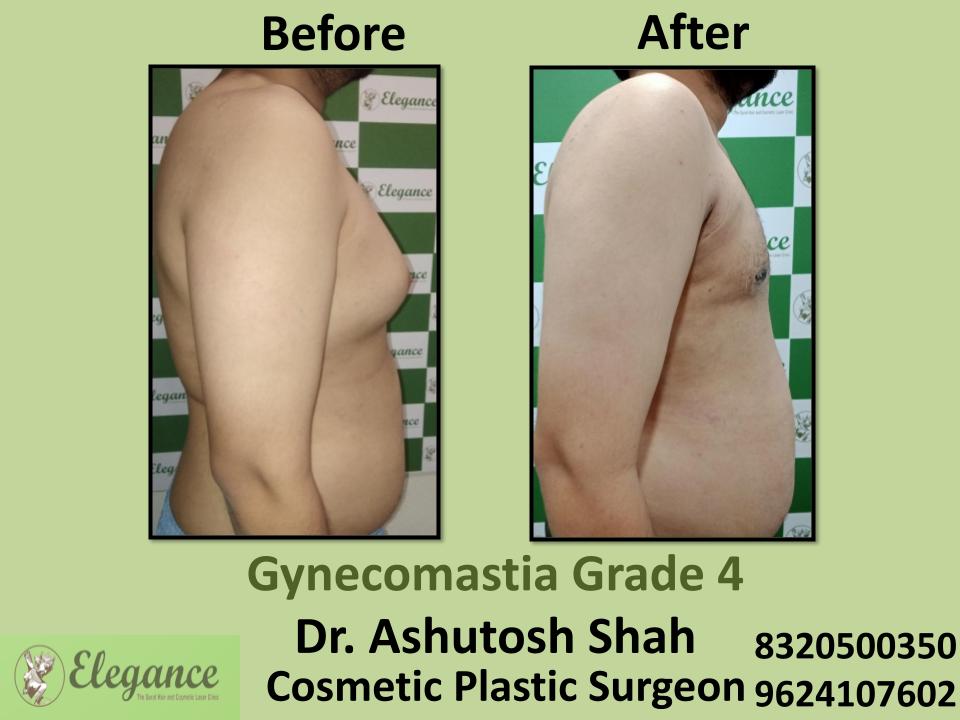 Gyencomastia Grade 4, Surgical Treatment Options, Marked As Asymmetry, Pandesara, Udhna, Bhatar, Surat, Gujarat.