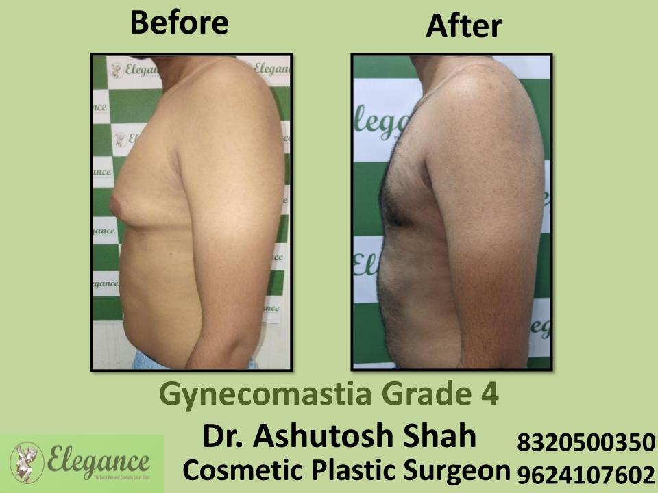 Gyencomastia Grade 4, Type Of Breast Swelling In Men, Athwa, Umra, Piplod, Vesu, Surat, Gujarat.