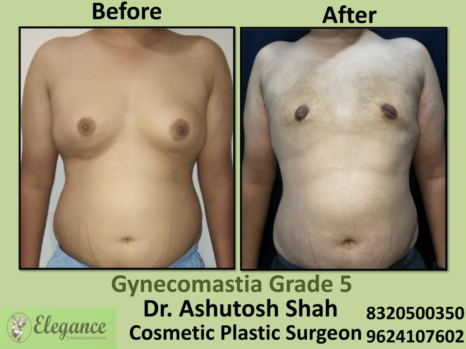 Gyencomastia Grade 5, Surgical Treatment, Fat Removing Process, Sarthana, Palanpor, Pal, Surat, Gujarat.