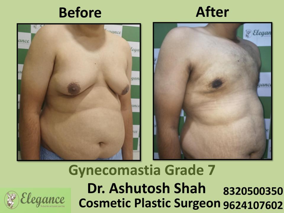 Gyencomastia Grade 7, Extreme Male Breast Growth, Surgery By Best Doctors, Navsari, Narmada, Bharuch, Surat, Gujarat.