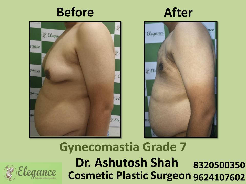 Gyencomastia Grade 7, Male Breast Appearance Concerns, Pal, Adajan, Hazira, Surat, Gujarat.