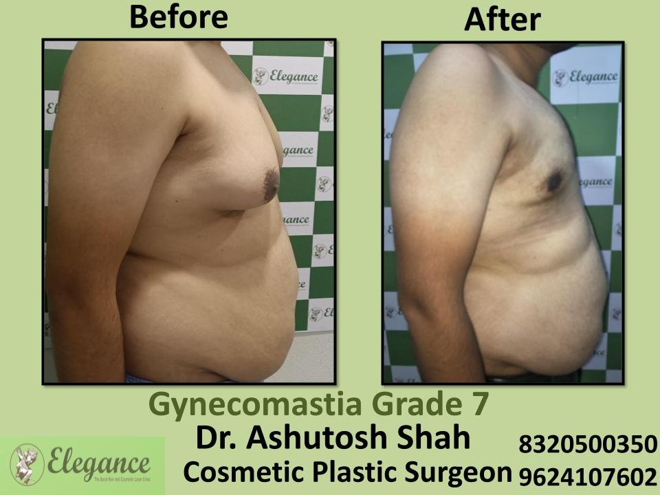 Gyencomastia Grade 7, Male Breast Enlargement, Removing Surgery, Ahemdabad, Vadodra, Gandhinagar, Surat, Gujarat.