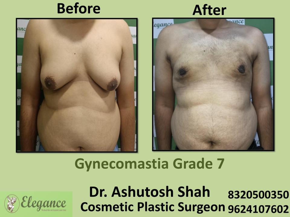 Gyencomastia Grade 7, Marked Breast Asymmetry In Males, Tapi, Valsad, Dang, Surat, Gujarat.