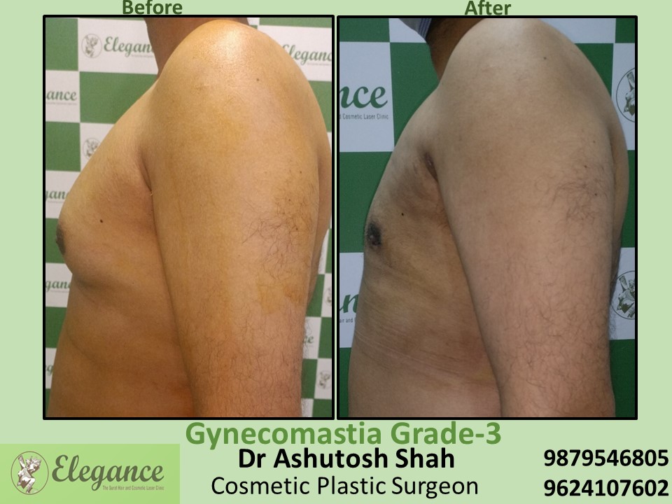 Gynecomastia Surgery at best price in Piplod, Katargam, Surat