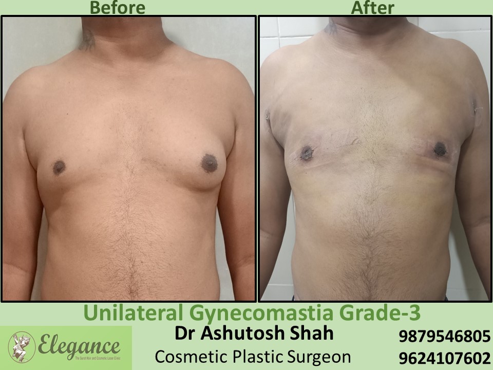 Low cost Surgery in Olpad, Surat