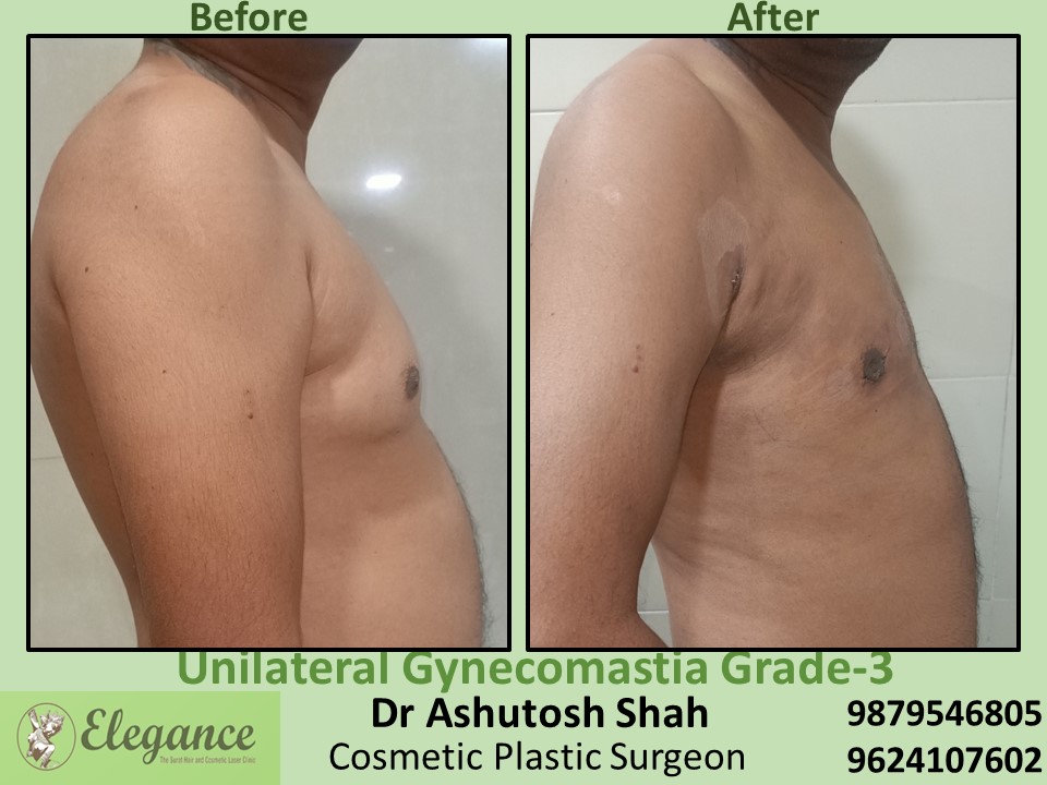 Male Breast Reductioin Surgery in Adajan, Surat