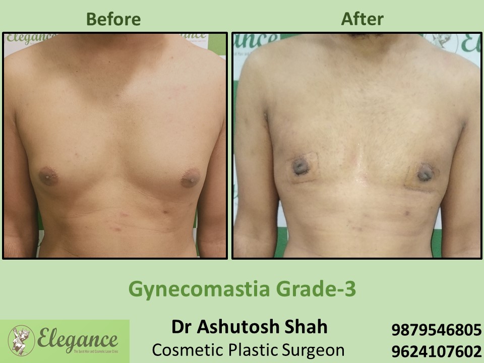 Male Breast Treatment in Ghod dod road, Surat