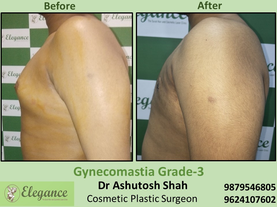 Painless and Best Breast Fat Removal Treatment for Male in Surat