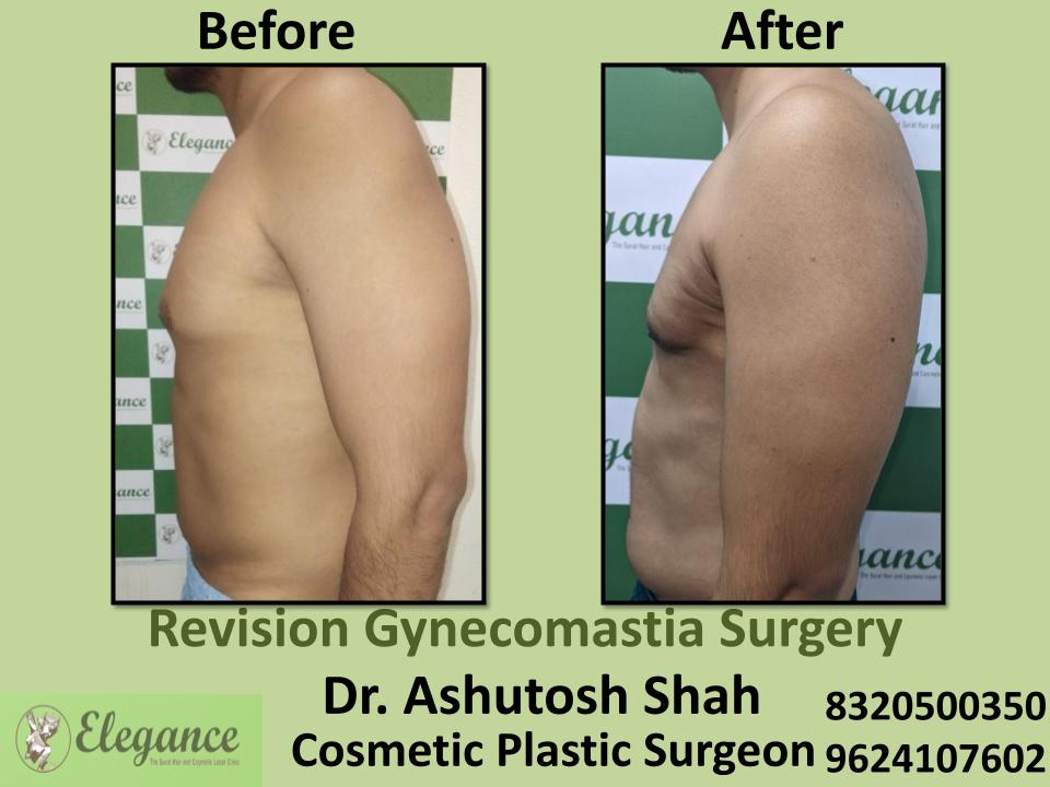 Revision Gynecomastia, Best Doctors, Surgery Recovery, Palgam, Vesu, Piplod, Surat, Gujarat.
