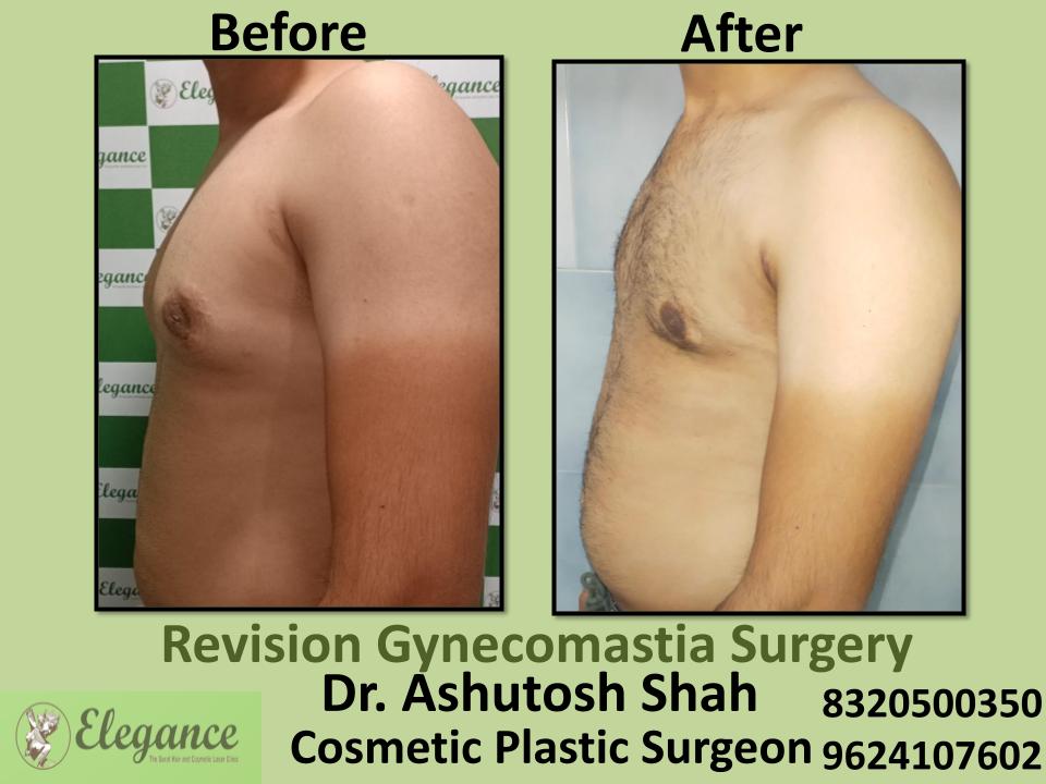Revision Gynecomastia, Secondary Gynecomastia Surgery, Rander, Adajan, Laldarwaja, Surat, Gujarat.