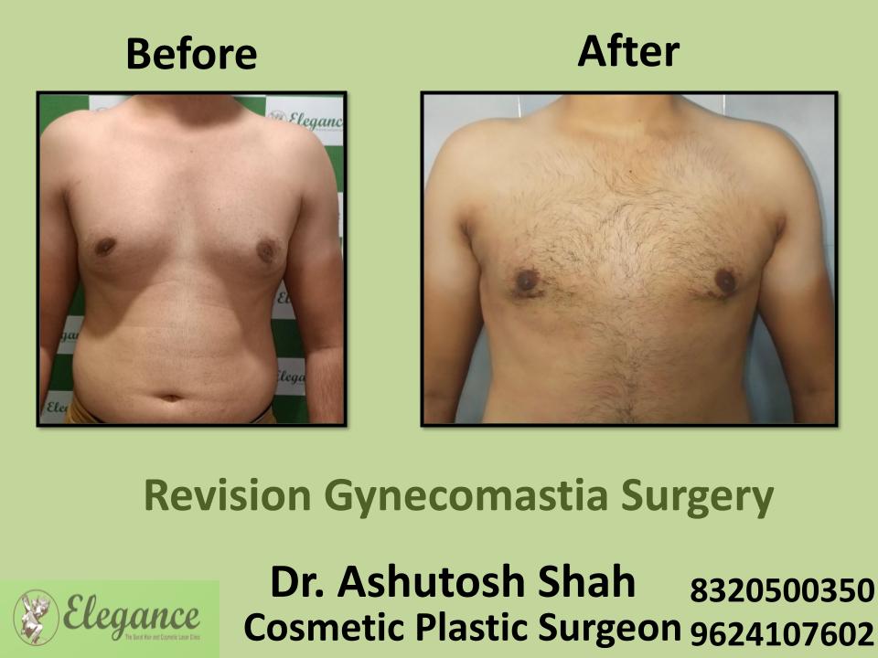 Revision Gynecomastia Surgery, Breast Glandular Swelling In Men, Tapi, Valsad, Dang, Surat, Gujarat.