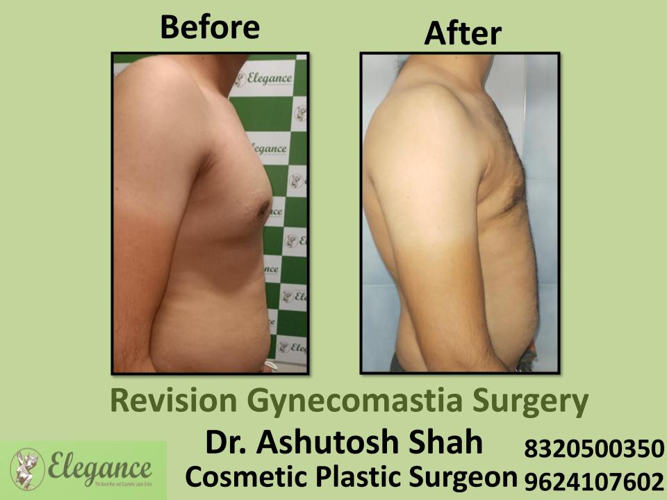 Revision Gynecomastia Surgery, Corrective Male Breast Reduction, Nanpura, Gopipura, Athwa, Surat, Gujarat.