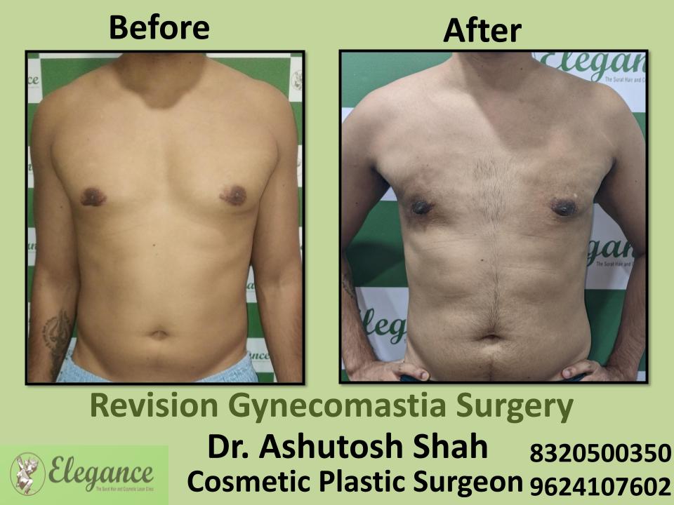 Revision Gynecomastia Surgery, Corrective Male Breast Reduction Tapi, Valsad, Dang, Surat, Gujarat.