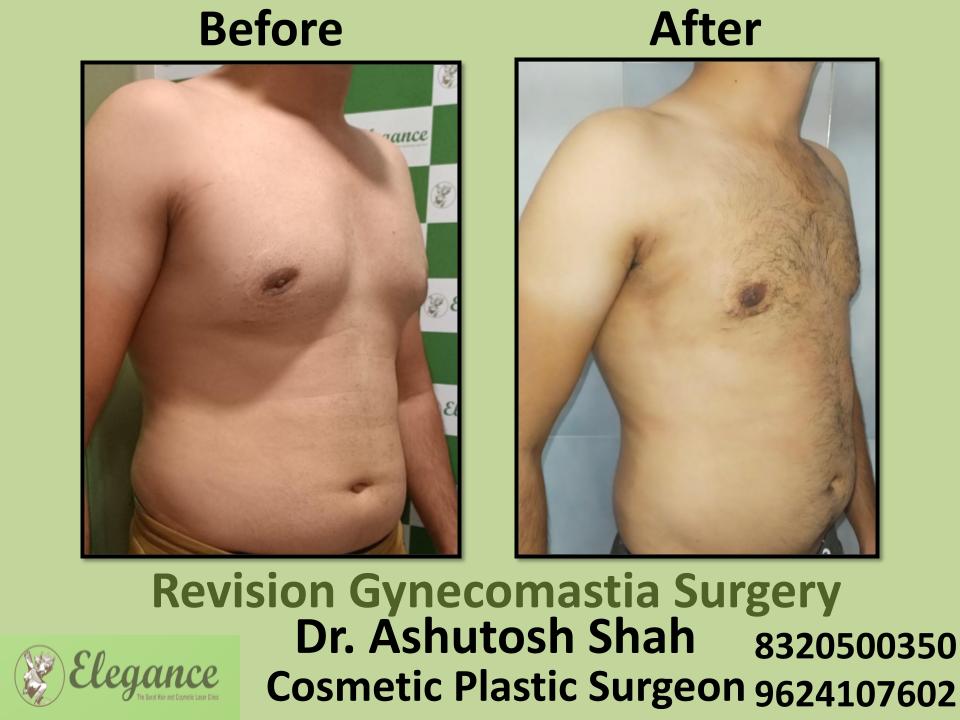 Revision Gynecomastia - Surgery For Enlarged Male Breast, Katargam, Umra, Athwa,  Surat, Gujarat.