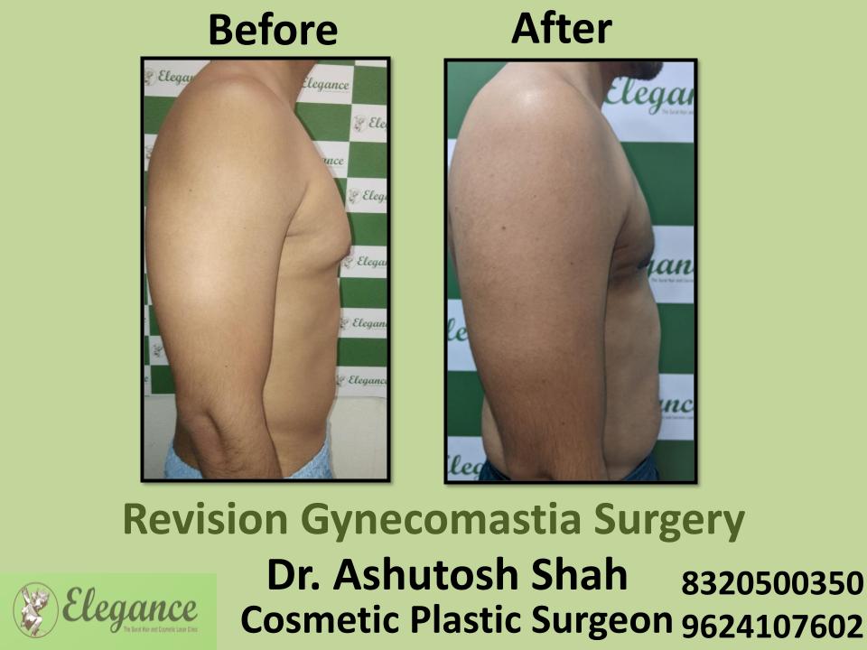 Revision Gynecomastia - Treatment And Recovery Of Gynecomastia Surgery, Dindoli, Pandesara, Udhna, Surat, Gujarat.