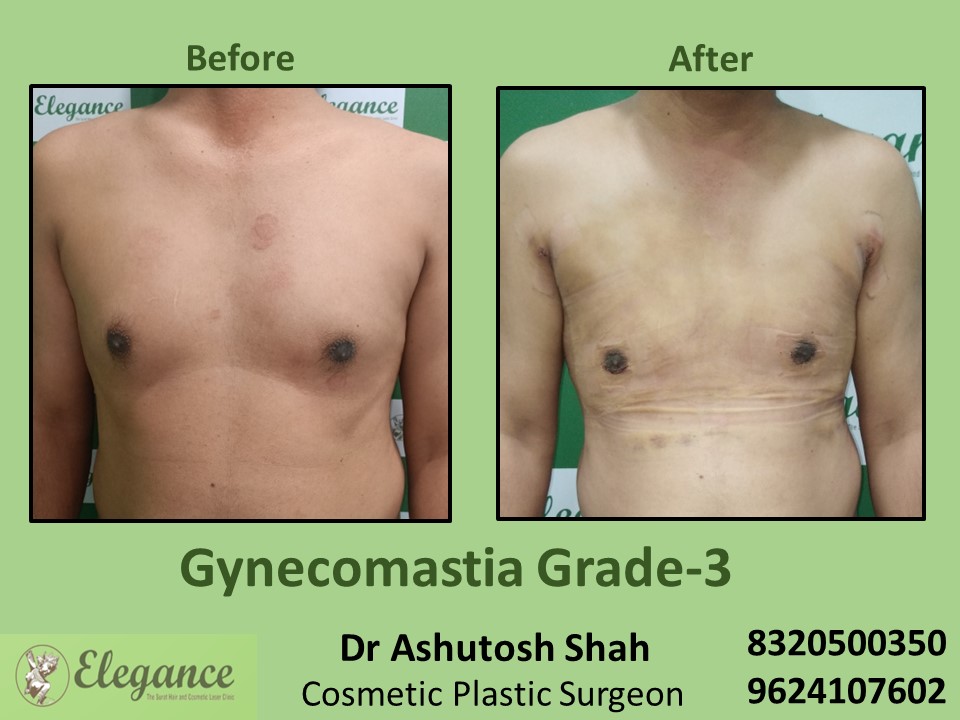 Gynecomastia Grade 3, Fat Reduction Treatment in Piplod, Surat