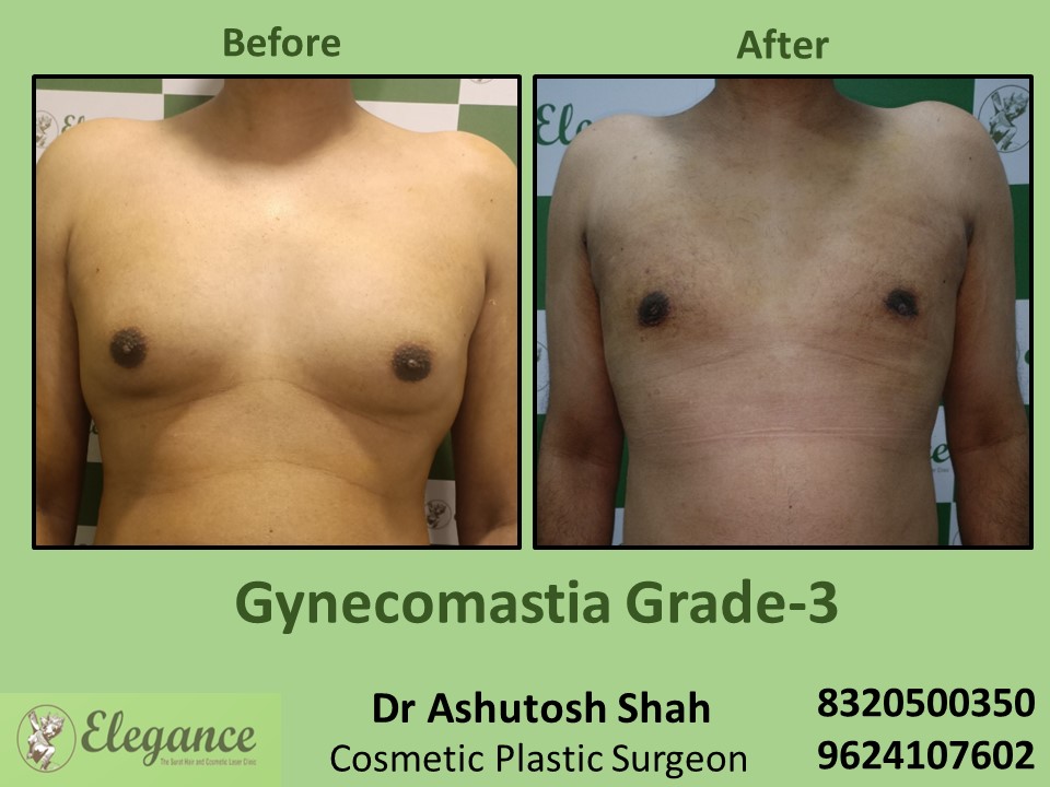 Male Boobs Reduction, Gynecomastia Grade 3 in Majuragate, Surat
