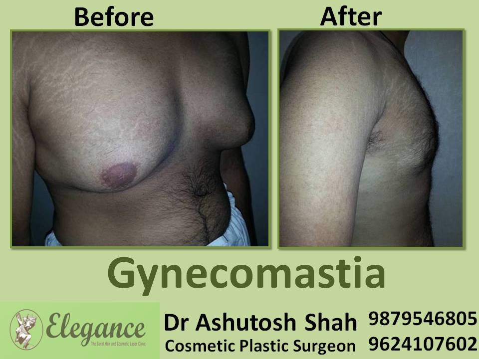 Gynecomestia Doctor In Ludhiana, Punjab, India