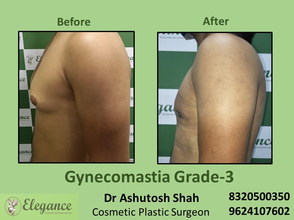 Male Boobs Reduction, Breast Fat Treatment, Gynecomastia Grade 3 in Vesu, Surat