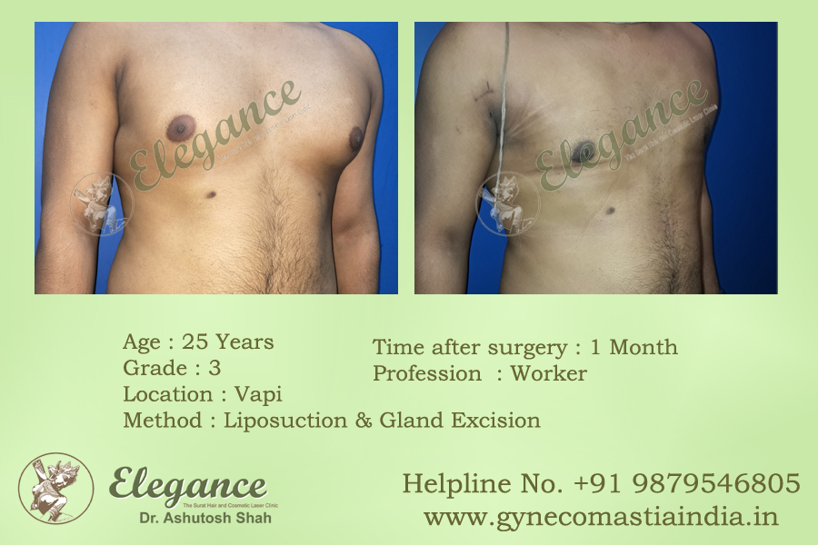Gynecomestia Surgery In Ludhiana, Punjab, India
