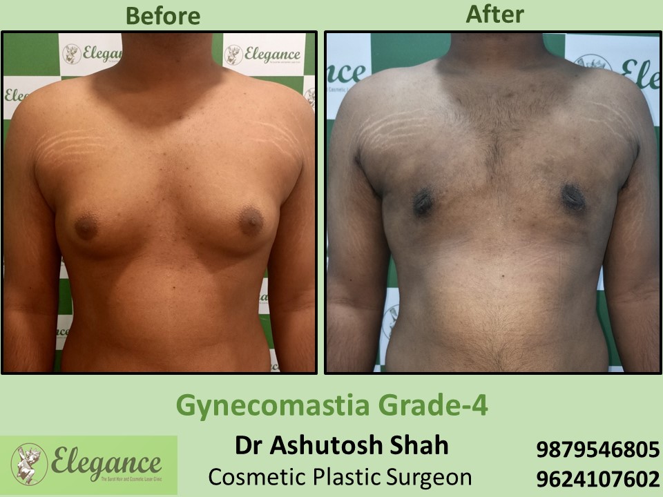 Best Treatment for Gynecomastia in Surat, Gujarat