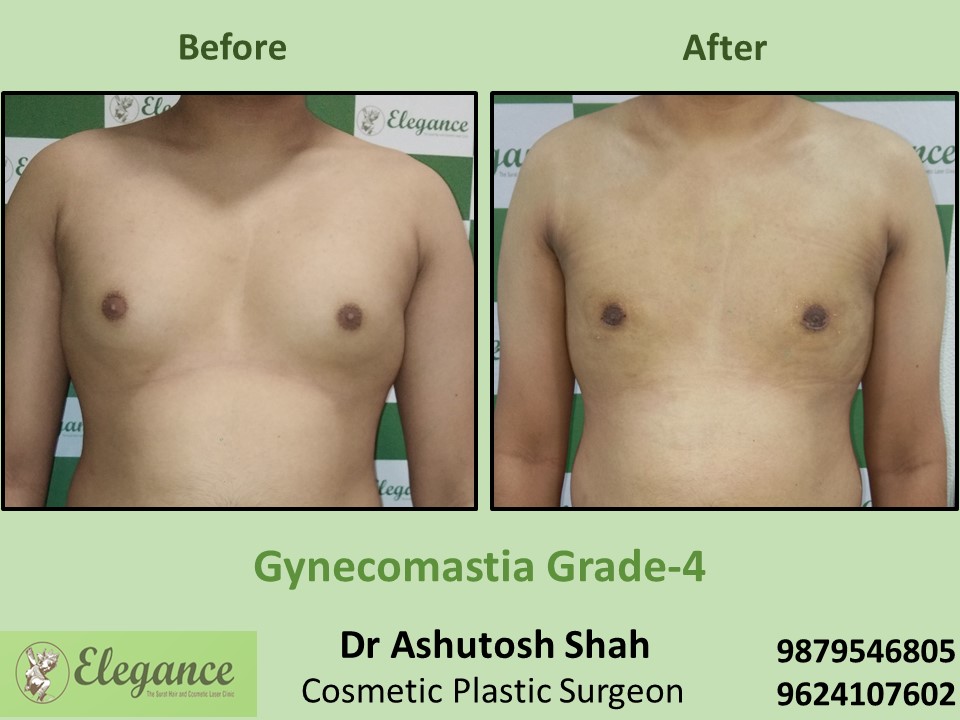 Extra Fat Reduction from Breast Male in Katargam, Vesu, Olpad, Surat