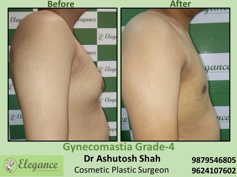 Fat Reduction Surgery in Male Breast at Dumas, Hazira , Surat