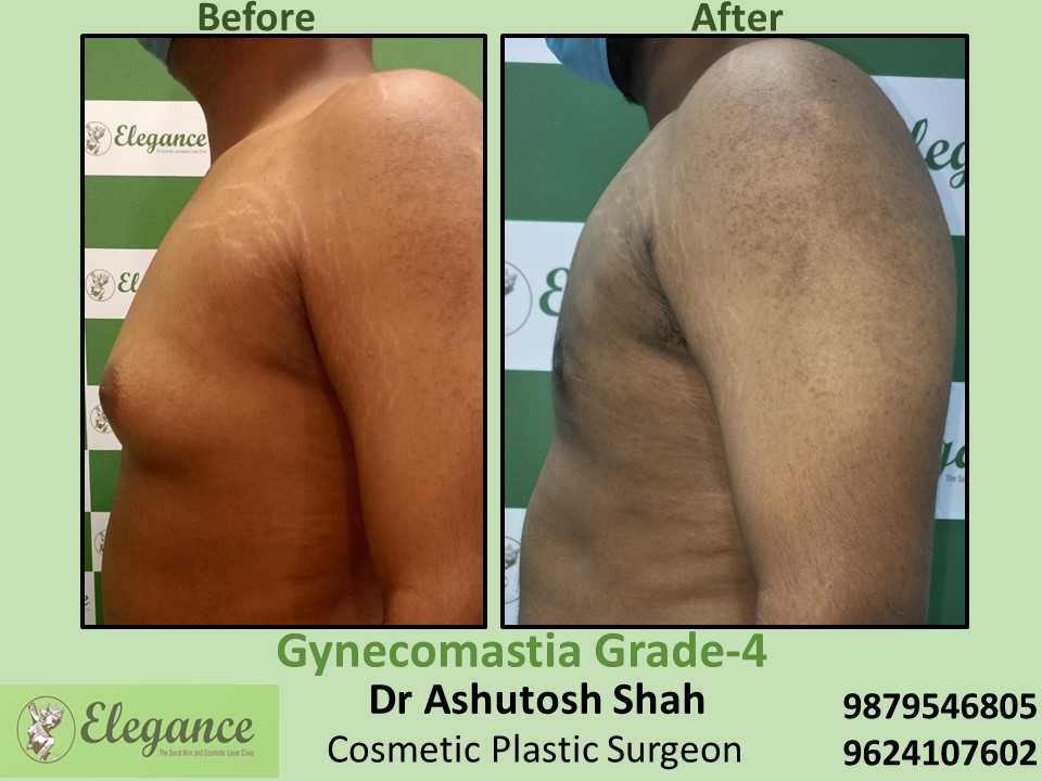 Gynecomastia Surgery Best Result in Surat, Gujarat