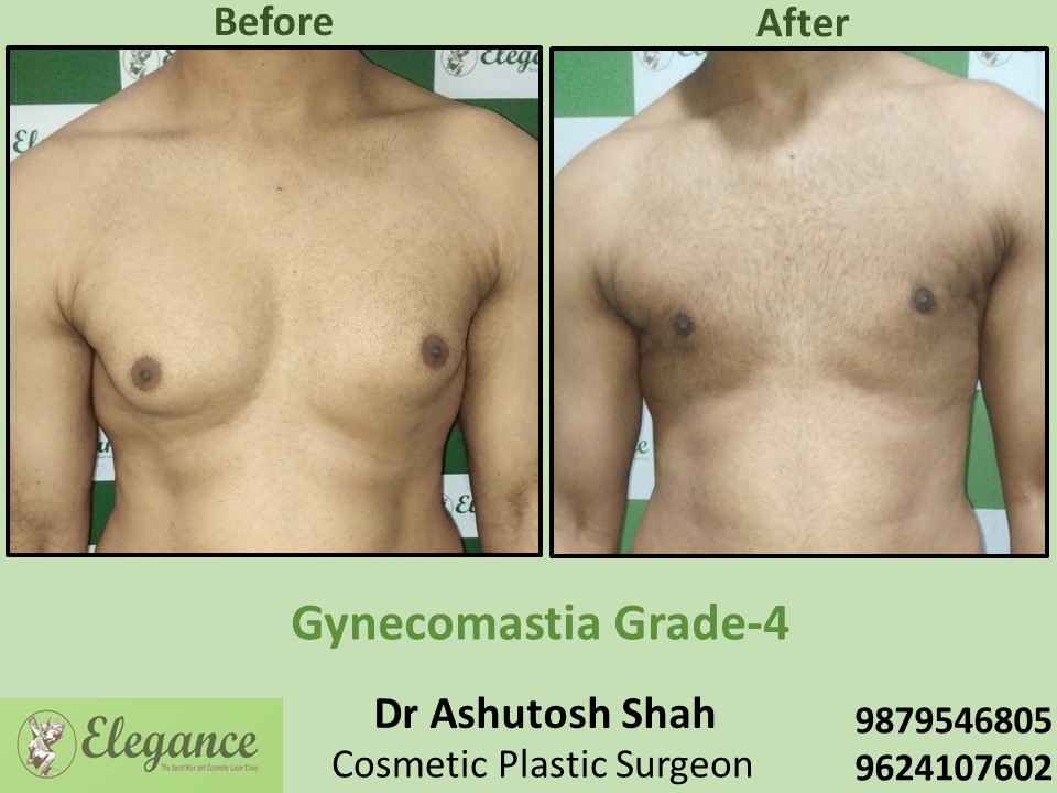Gynecomastia Treatment at Low cost in Vesu, Surat