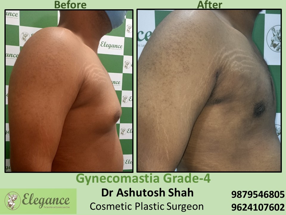 Low cost treatment for male breast surgery in Varachha, Rander, Surat