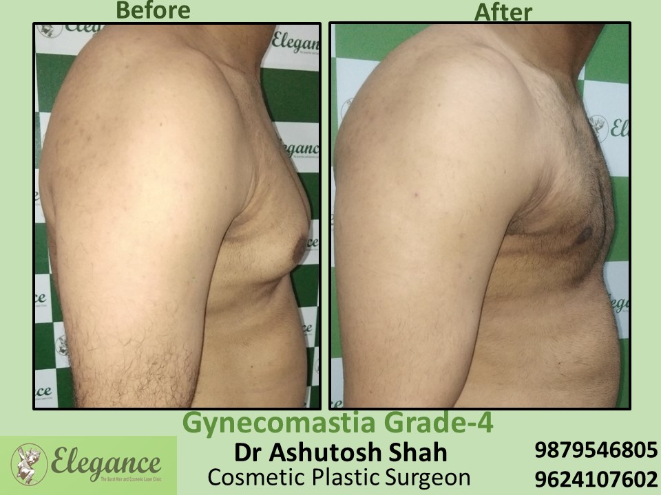 Male Breast Surgery in Piplod, Athwagate, Surat