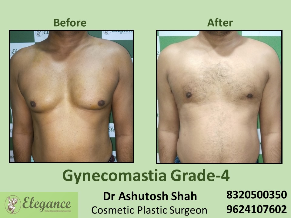 Gynecomastia Grade 4 | Breast Reduction in Surat