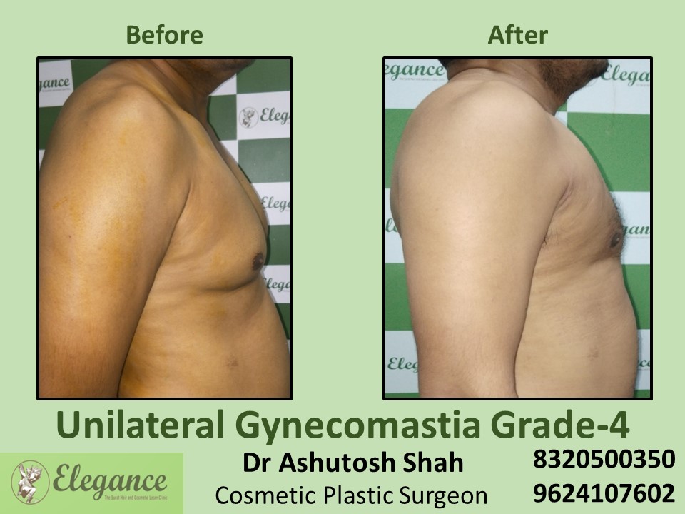 Gynecomastia Grade 4 | Breast Reduction in Vesu, Surat