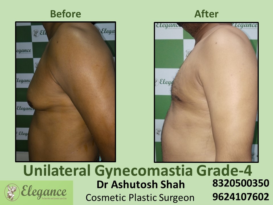 Unilateral Gynecomastia Grade 4 | Breast Reduction in Vesu, Piplod, Surat