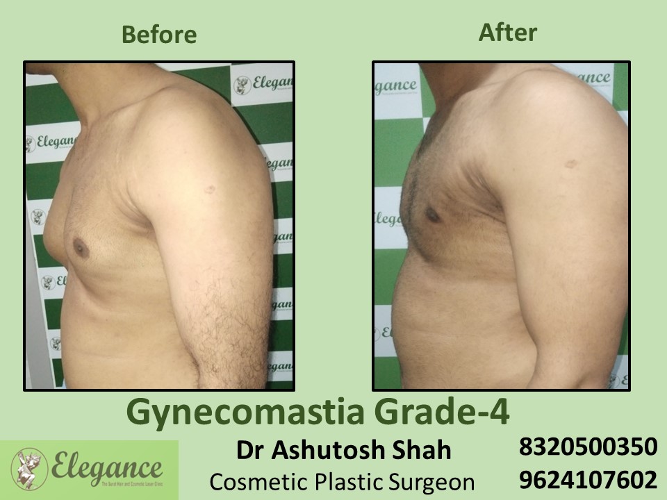 Gynecomastia Grade 4 | Male Boobs Reduction in Piplod, Surat