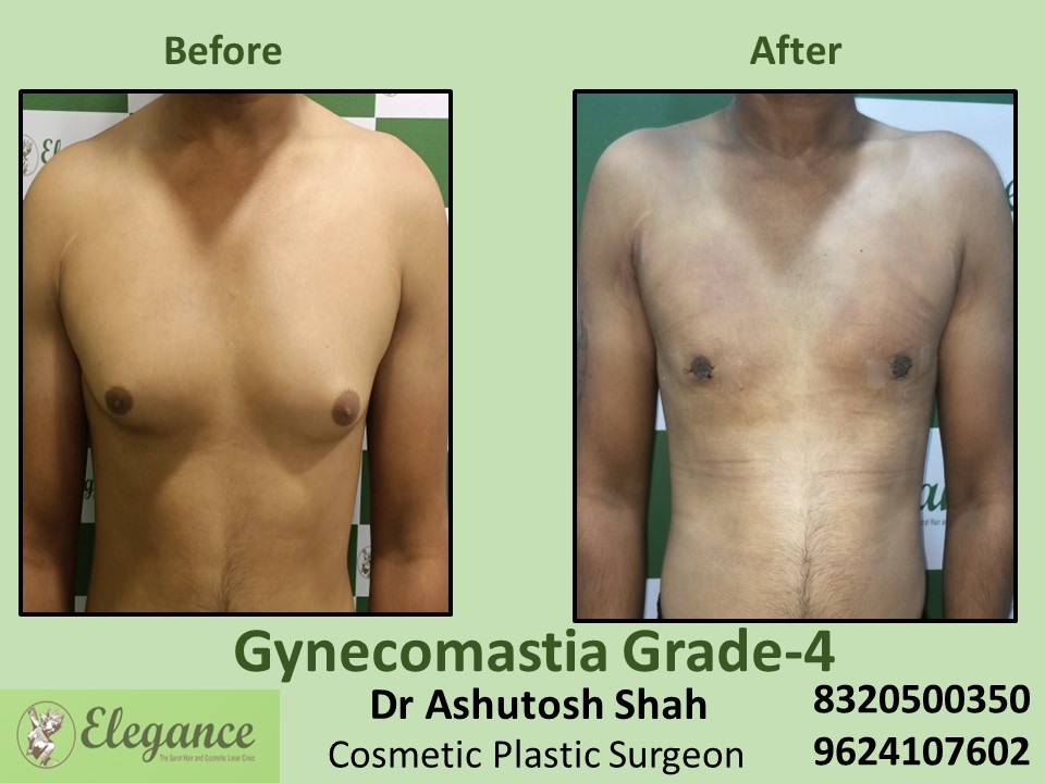 Gynecomastia Grade 4 | Male Boobs Reduction in Piplod, Udhna, Surat