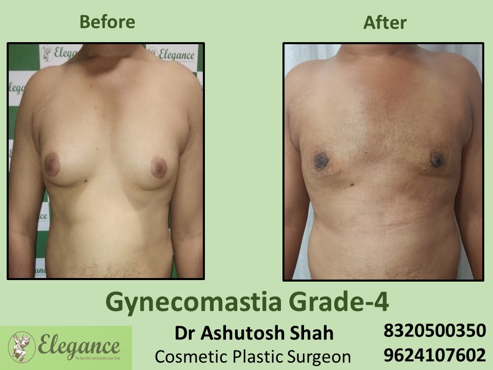Gynecomastia Grade 4 | Male Boobs Reduction in Udhna, Surat