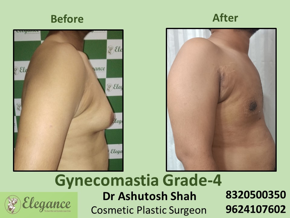 Male Fat Reduction | Male Gynecomastia Grade 4 Treatment, Athwalines, Surat